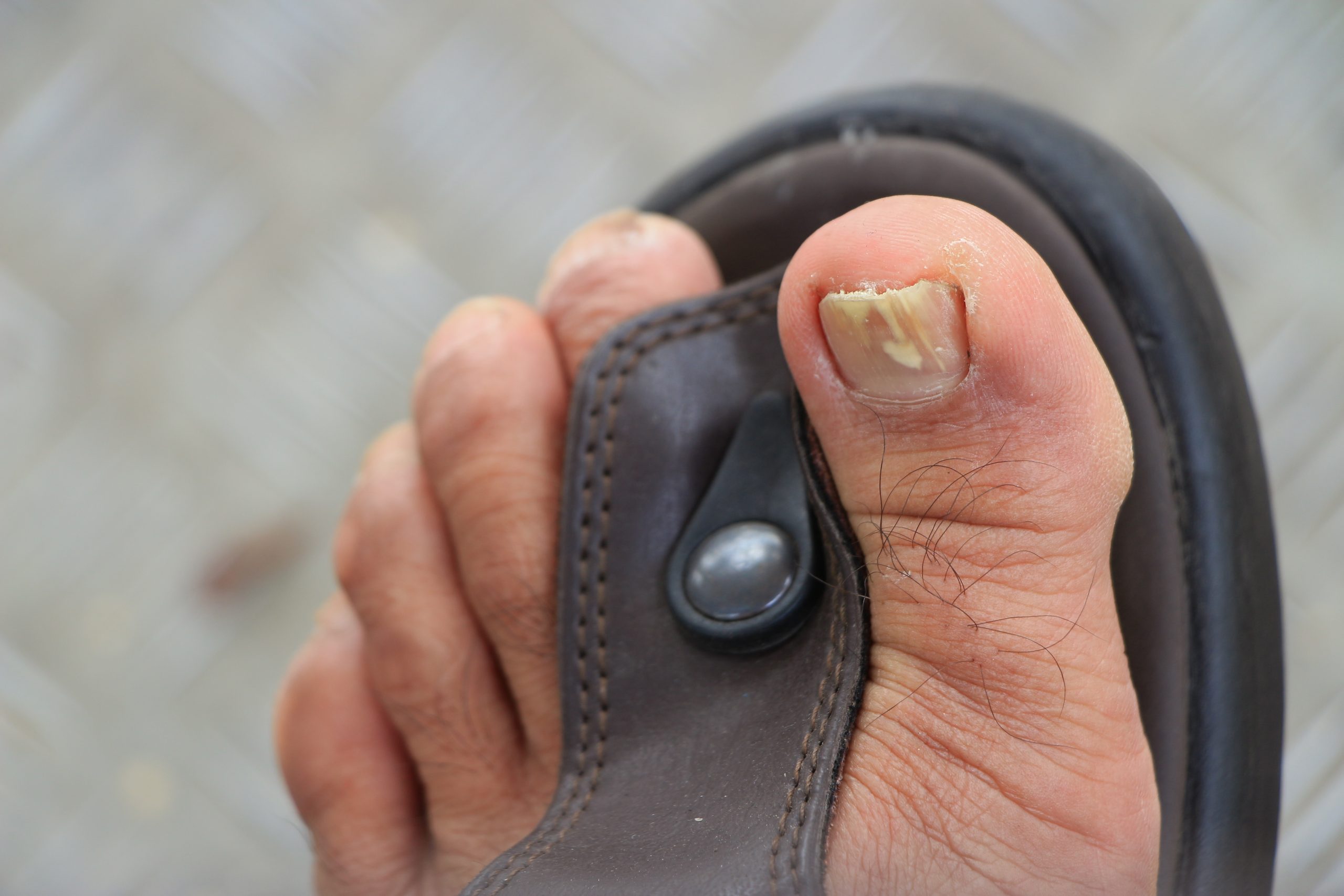 The common causes of toenail fungus